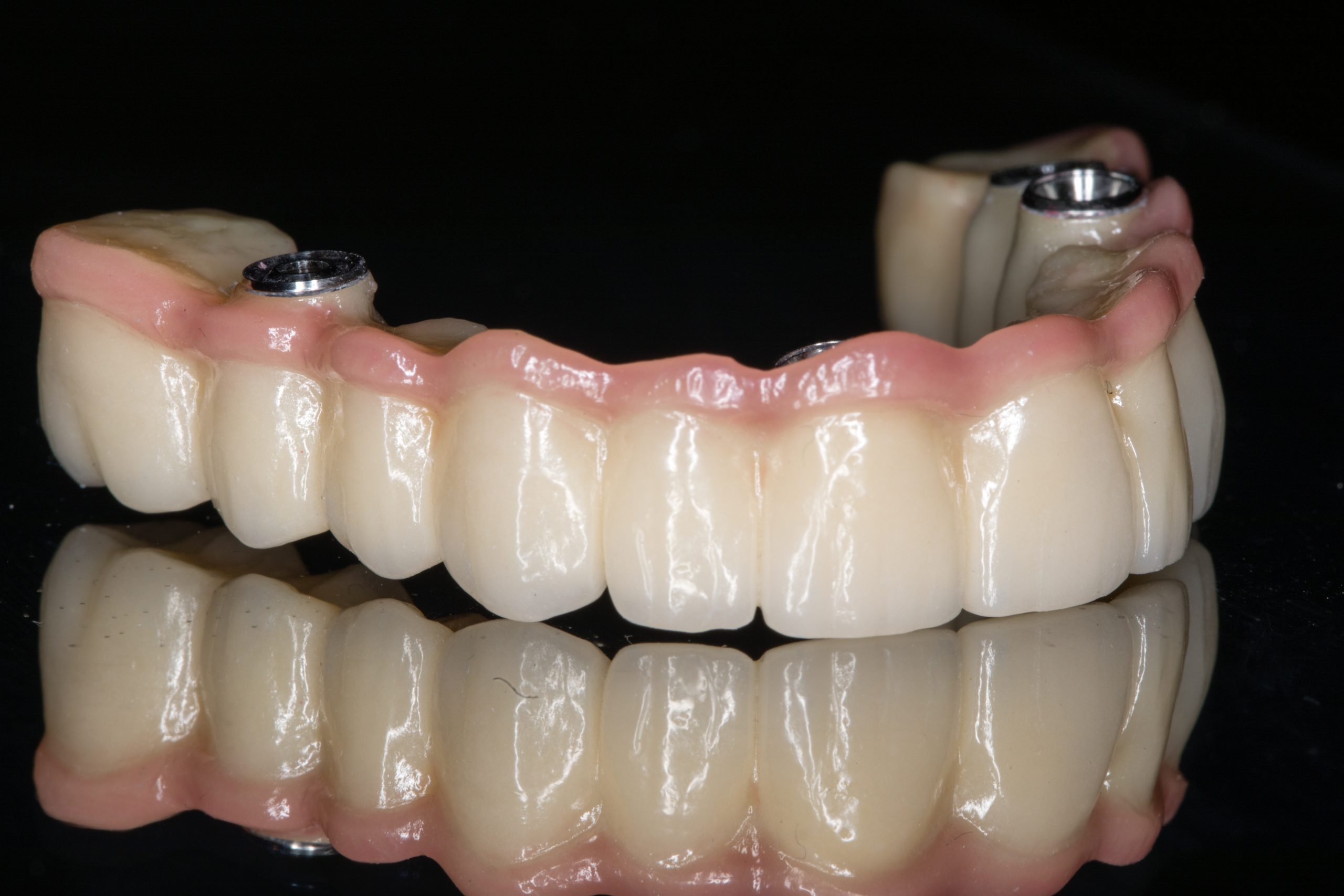 Implant Denture